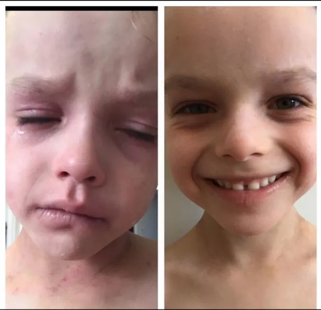 Mom cures sons severe eczema with a cream she found through Facebook
