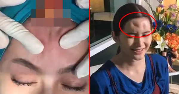 nong guang infected filler wrinkles cosmetic surgery