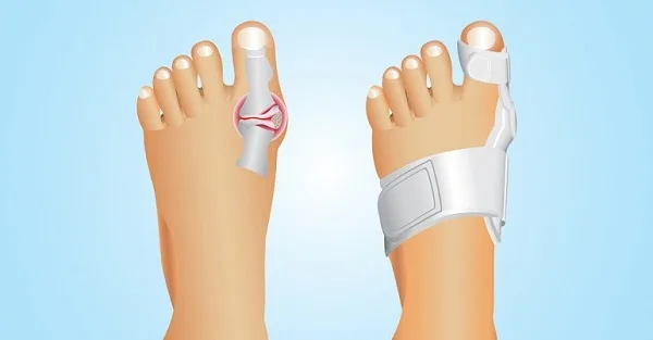 GET RID OF BUNIONS COMPLETELY NATURALLY