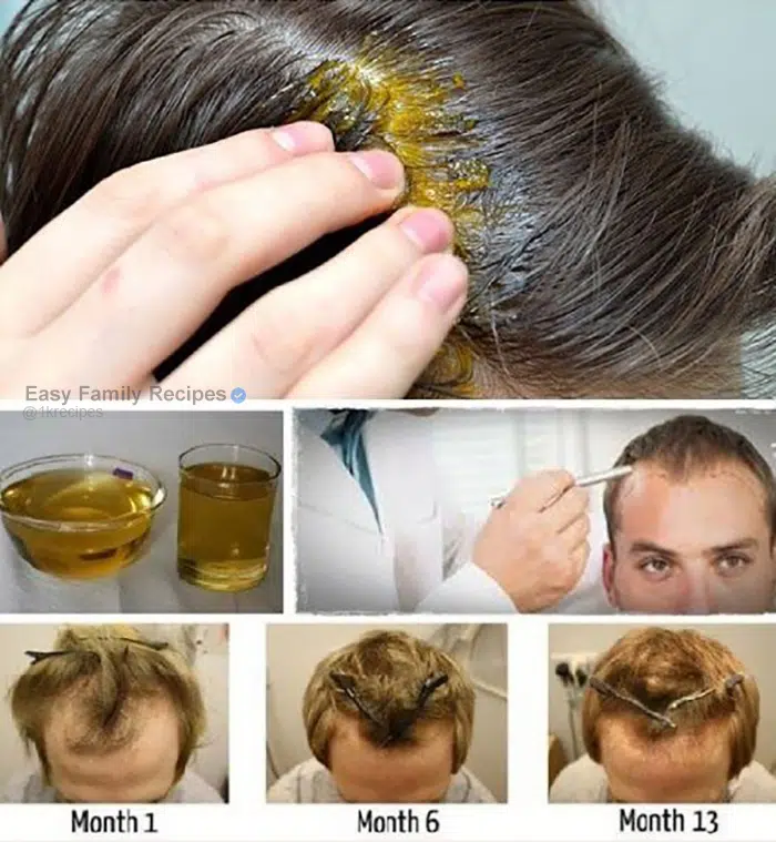 IT ONLY TAKES ONE INGREDIENT TO SAVE AND REGROW YOUR HAIR