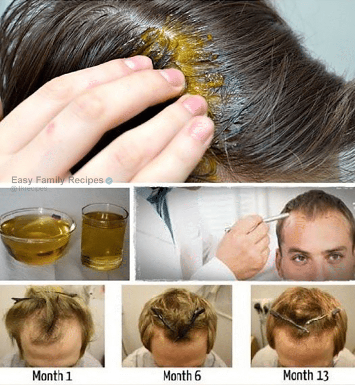 IT ONLY TAKES ONE INGREDIENT TO SAVE AND REGROW YOUR HAIR 1 IT ONLY TAKES ONE INGREDIENT TO SAVE AND REGROW YOUR HAIR
